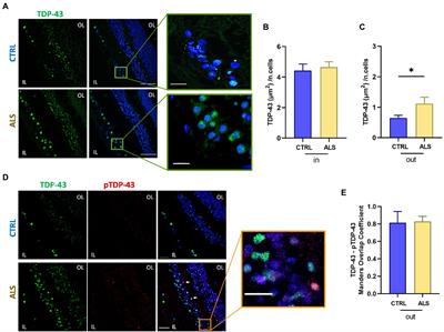 Retinal fingerprints of ALS in patients: Ganglion cell apoptosis and TDP-43/p62 misplacement